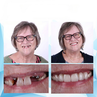 Denture Adhesive Perfect Fit Reline Kit Secure Hold - Image 5